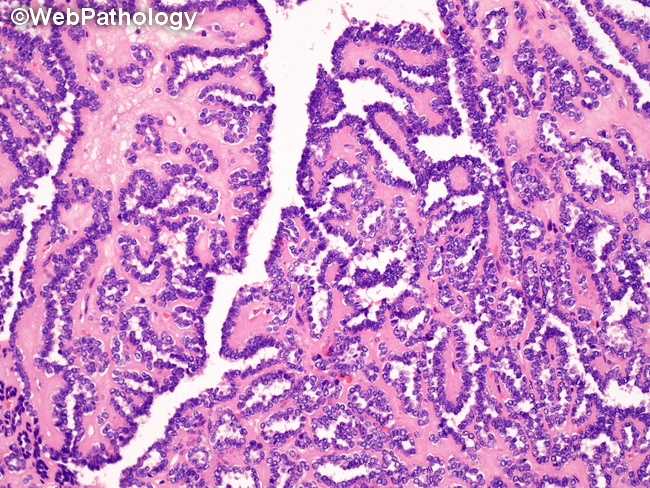 Kidney_MetanephricAdenoma56_Papillary.jpg