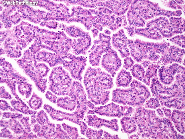 Kidney_PapillaryRCC16.jpg