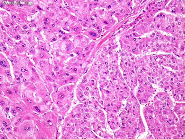 Hepatocellular Carcinoma Histology