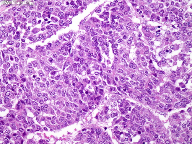Liver_Hepatoblastoma12_Embryonal.jpg