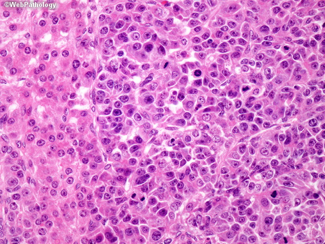 Liver_Hepatoblastoma20_Embryonal.jpg