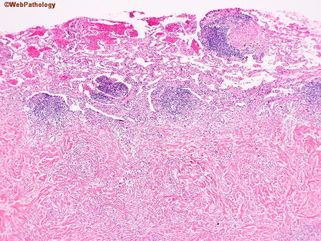 Lung_HyalinizingGranuloma1.jpg