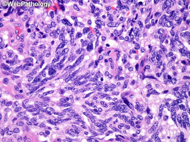 Lung_Neoplastic_Carcinoid_Spindle2.jpg