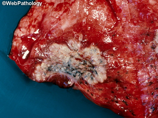 Lung_Neoplastic_SCC_Gross3_cropped.jpg