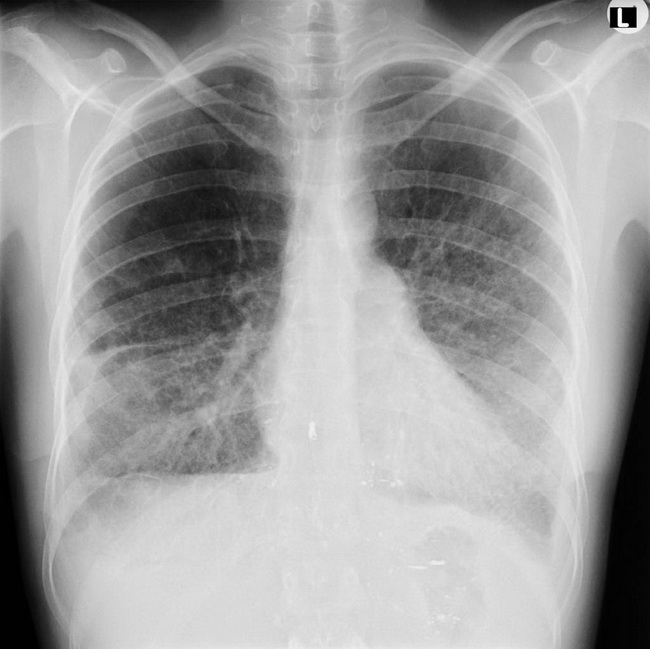 Lungs_LAM_Radiology1.jpg