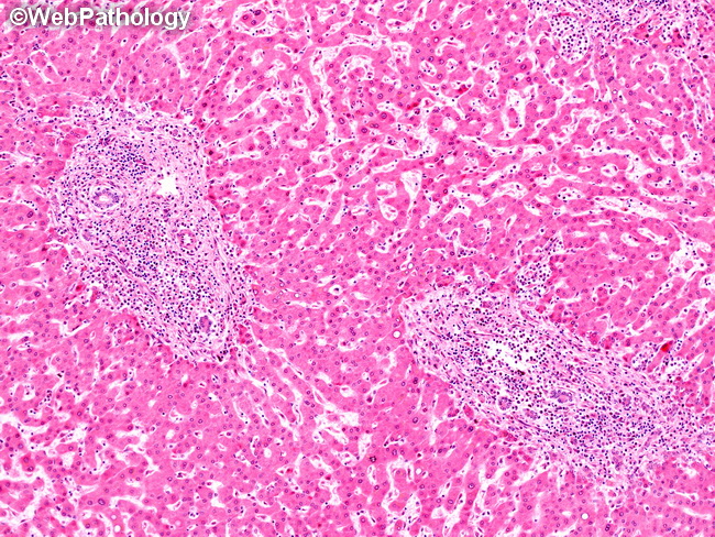 Mastocytosis_Liver10.jpg