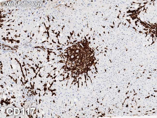 Mastocytosis_Liver3_CD117.jpg