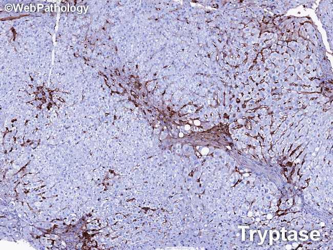 Mastocytosis_Liver6_tryptase.jpg
