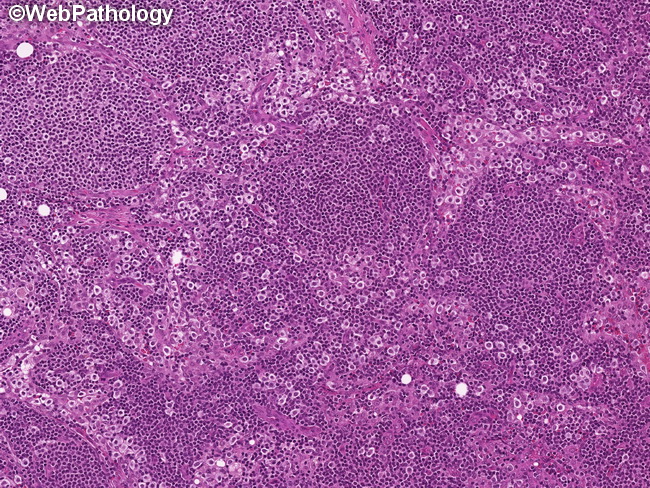 Mastocytosis_LymphNode12.jpg