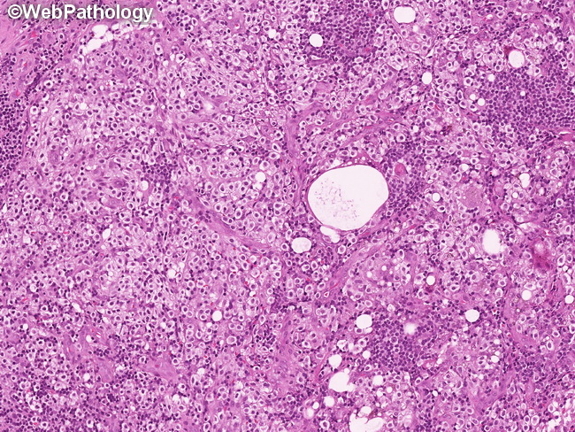 Mastocytosis_LymphNode15.jpg