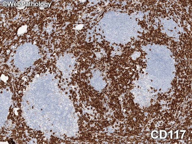 Mastocytosis_LymphNode2_CD117.jpg