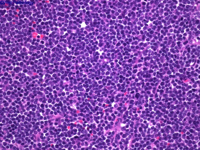 lymphoblast cell