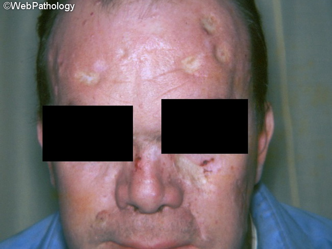 nevoid basal cell carcinoma syndrome