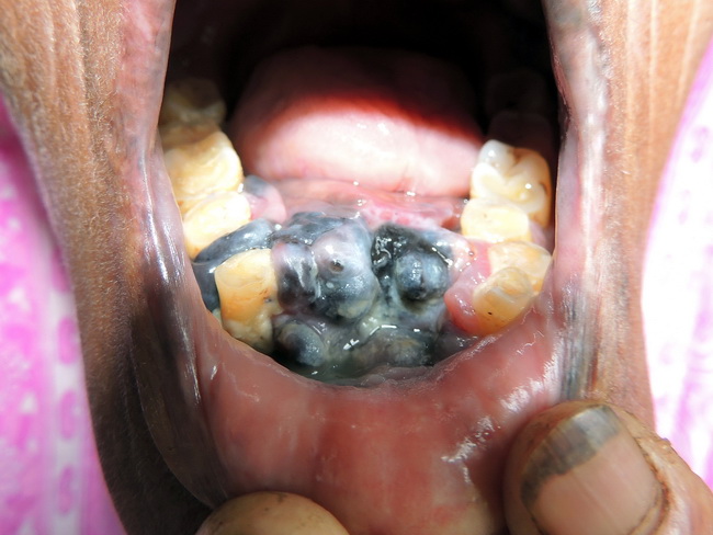 oral malignant melanoma