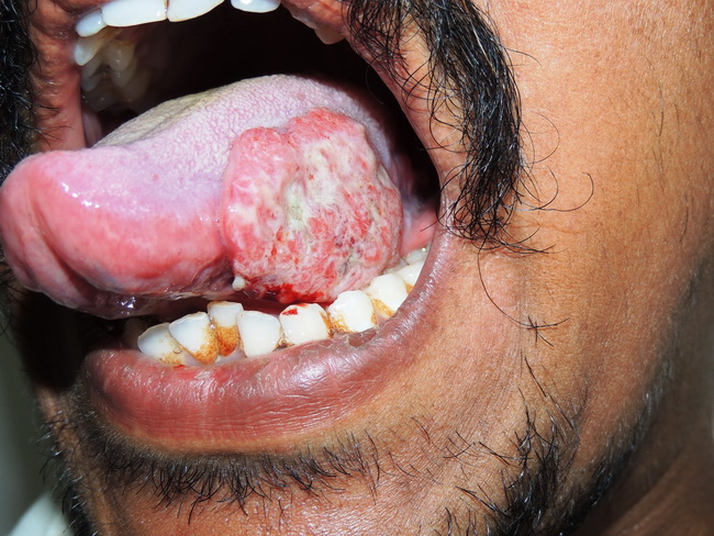 squamous cell carcinoma tongue