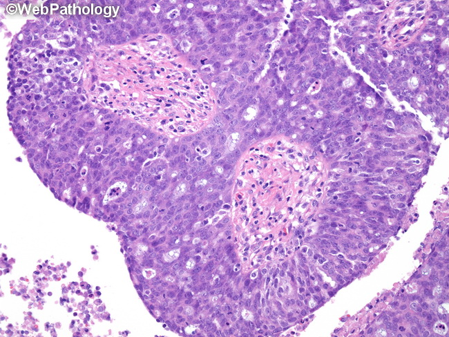 Serous Ovarian Cancer Histology Cancerwalls