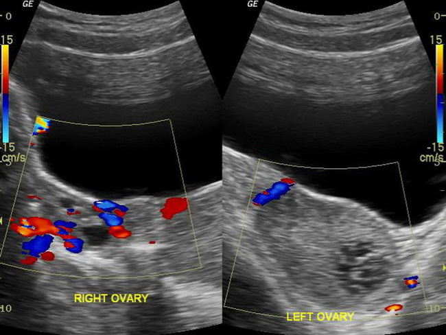 Ovarian Torsion Histology
