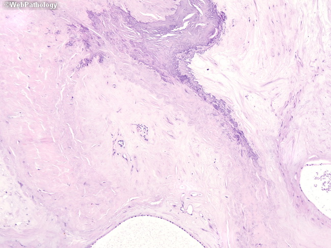 Pancreas_MicrocysticCystadenoma6_StromalCalcification.jpg