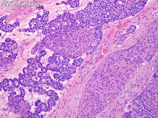 Pancreas_Pancreatoblastoma12.jpg