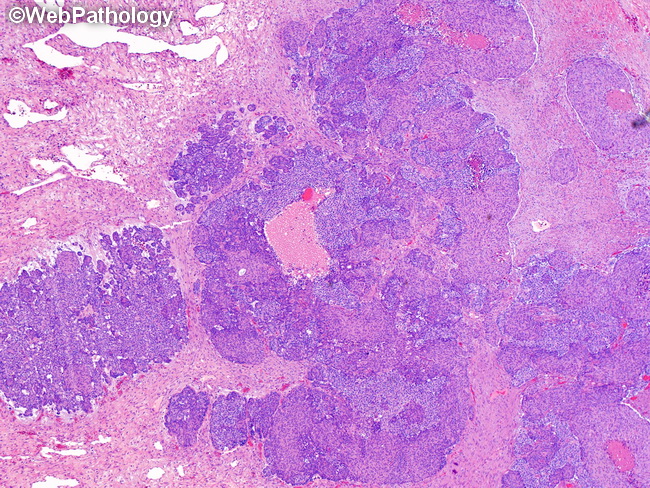 Pancreas_Pancreatoblastoma6.jpg