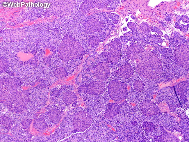 Pancreas_Pancreatoblastoma7.jpg