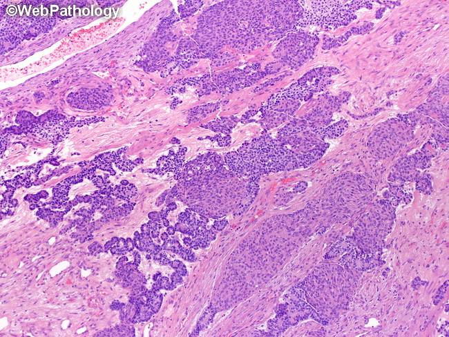 Pancreas_Pancreatoblastoma9.jpg