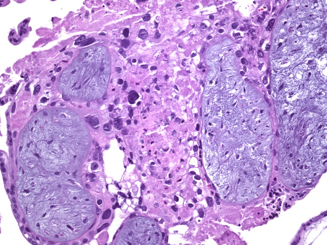 Placenta_CompleteMole3_CytologicAtypiaIntTrophoblast.jpg