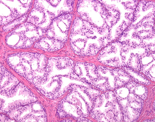 benign prostate hyperplasia pathology outlines Rózsaszín prosztatitis húsleves