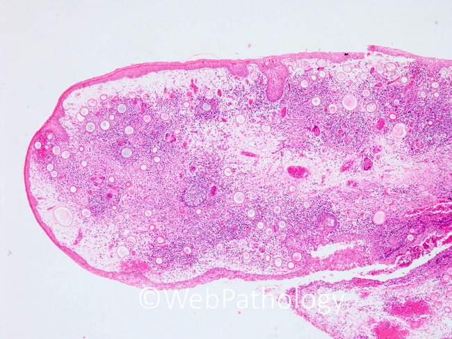 Rhinosporidiosis1_Nose.jpg