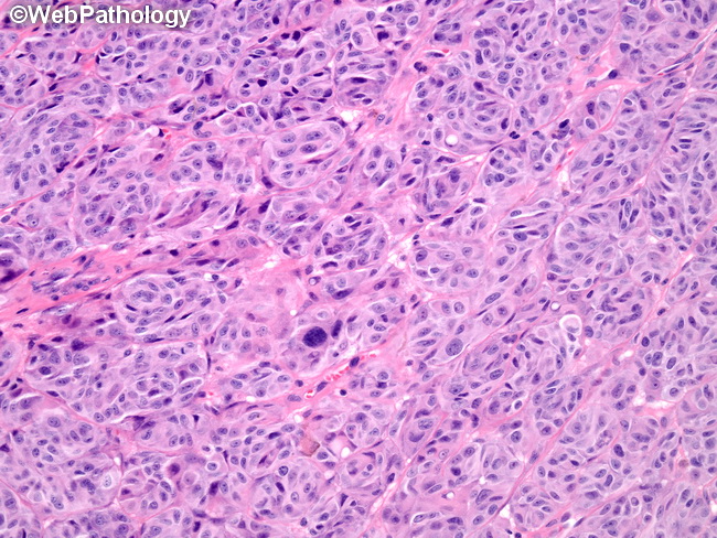 nodular melanoma histology