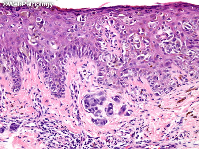View Malignant Melanoma Histology Pictures
