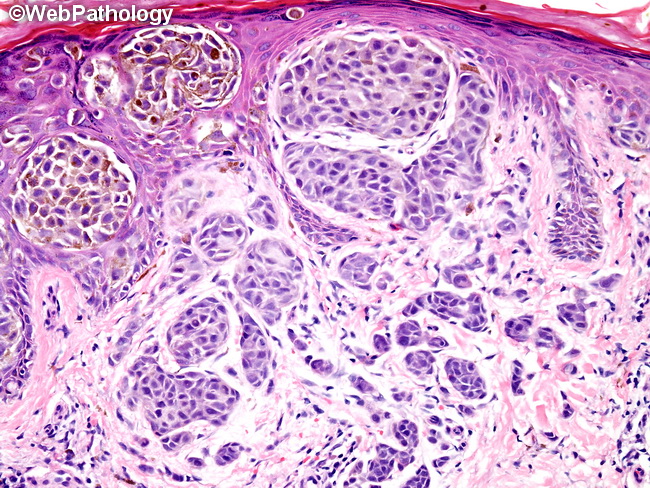 invasive melanoma histology