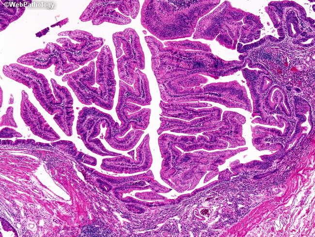 villous adenoma histology
