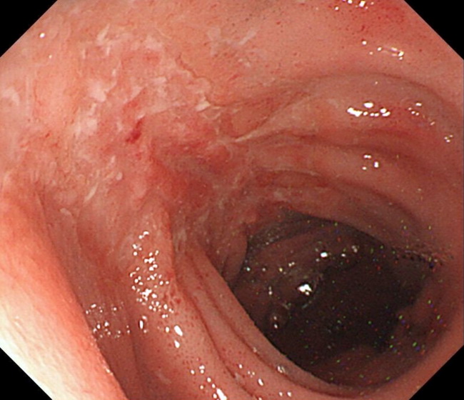 SmallBowel_Crohn_endoscopy1_resized.jpg