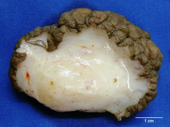 SoftTissue_CollagenousFibroma3_resized.JPG