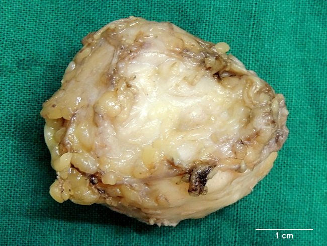 fibroma of tendon sheath
