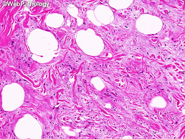 spindle cells and ropey collagen- found in spindle cell lipomas