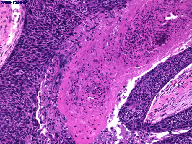 Squamous Cell Carcinoma Histology Ear