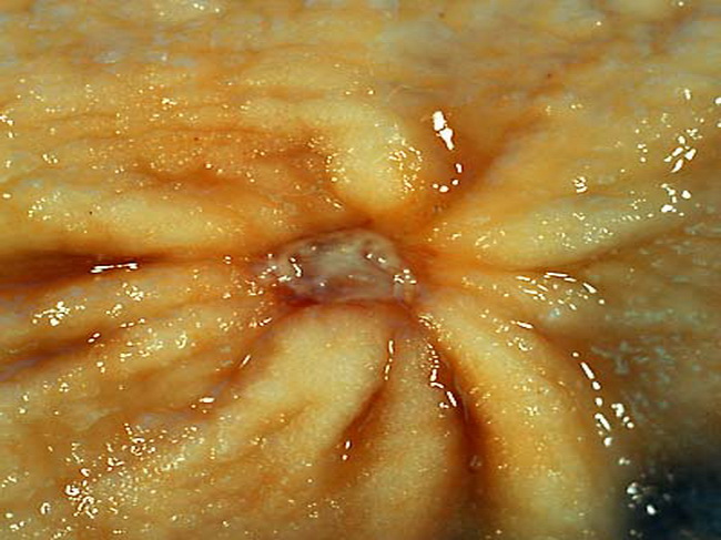 gastric ulcer histology