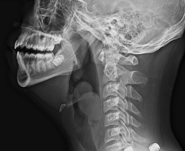 SynovialSarcoma_Radiology2A_resized.jpg