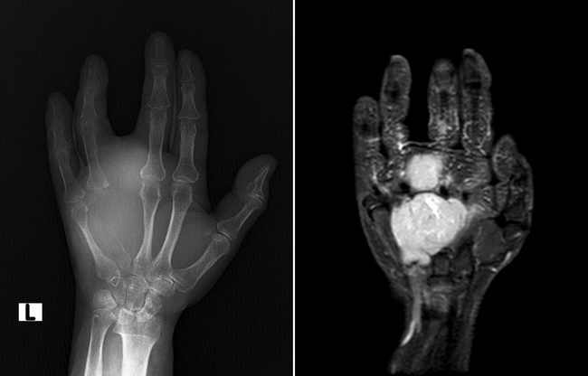 SynovialSarcoma_Radiology3_Composite_resized.jpg