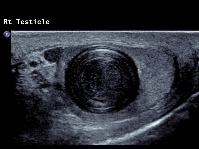 Testis_EpidermoidCyst6_Ultrasound.jpg