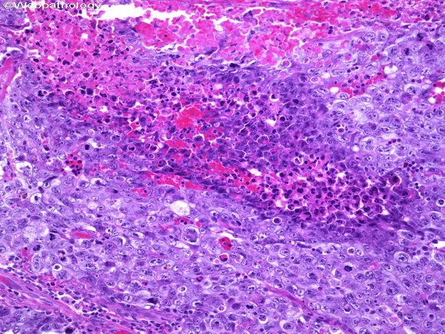 coagulative necrosis liver