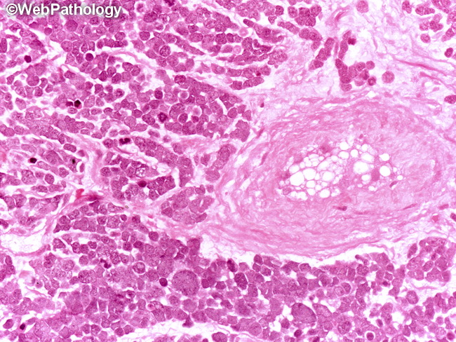merkel cell carcinoma histology