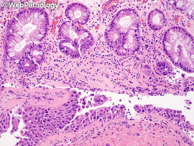 UrinaryBladder_Diverticulum17_CIS_IntestinalMetaplasia.jpg