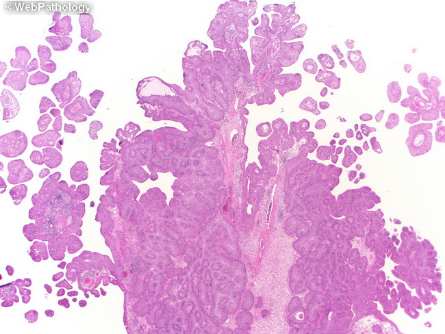 exophytic papilloma of bladder