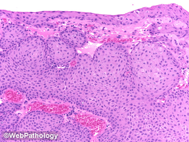 UrinaryBladder_InvertedPapilloma14_cropped.jpg