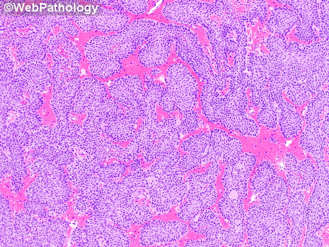 UrinaryBladder_InvertedPapilloma23D.jpg