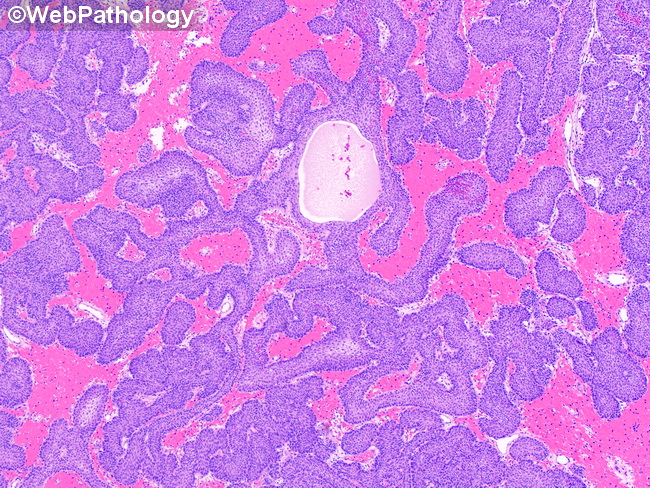 UrinaryBladder_InvertedPapilloma23E.jpg