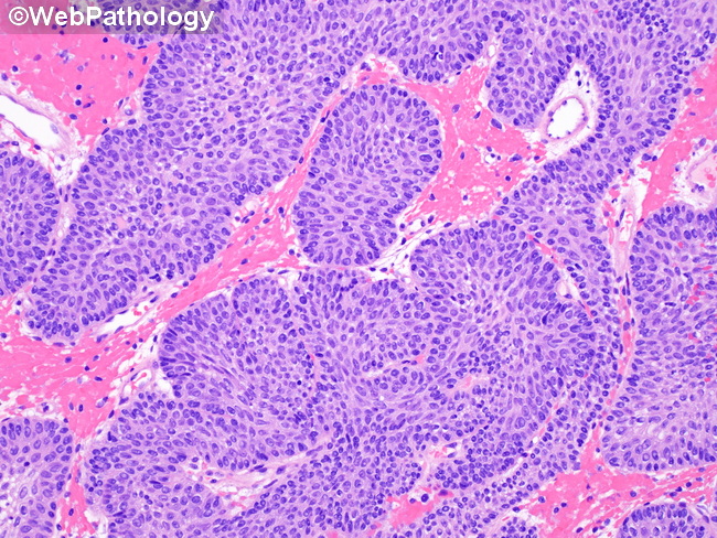 UrinaryBladder_InvertedPapilloma23F.jpg